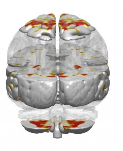 Areas in red show increased symmetrical activity in musicians between the left and right brain hemispheres while listening to music.