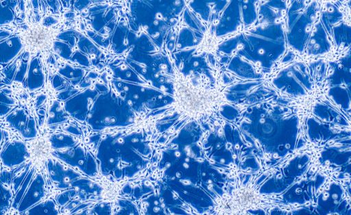 Glioblastoma brain cancer cells under microscope